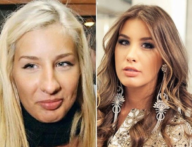 10 знаменитостей которым пластика явно пошла на пользу